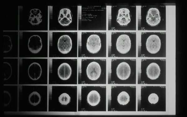 Nauja viltis: smegenų stimuliacija, nukreipta į SCAN, rodo geresnius Parkinsono gydymo rezultatus