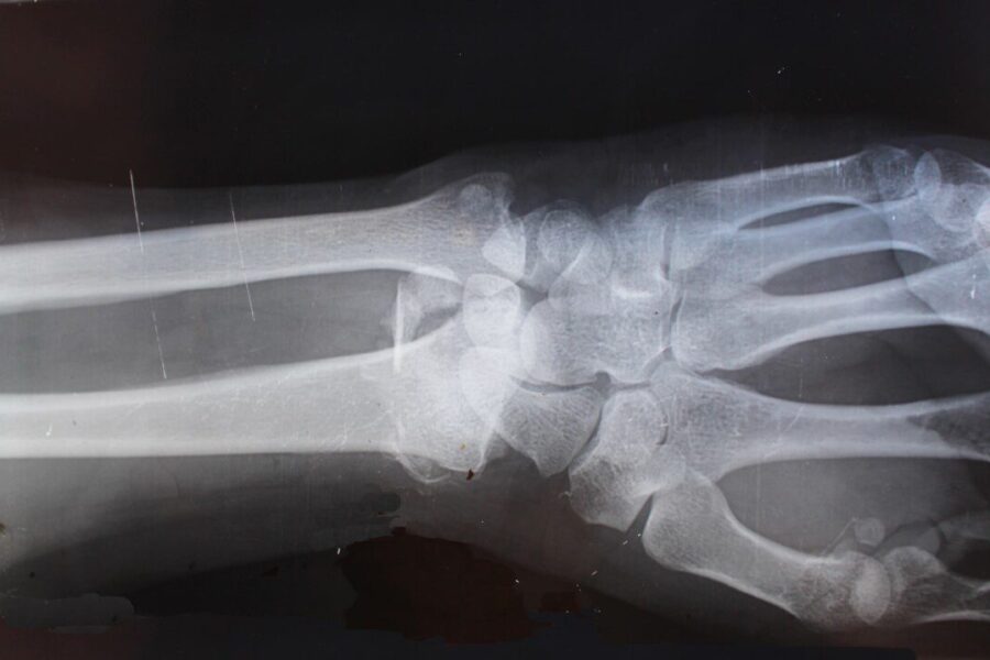 Proveržis, kuris gali pakeisti milijonų likimus: atskleidė, kaip EV gali sustabdyti osteoartritą