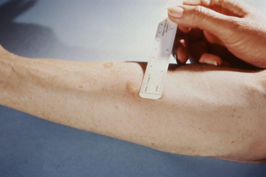 Ukraina atsisako Mantoux mėginio: pereina prie tikslesnio kraujo tyrimo tuberkuliozės nustatymui
