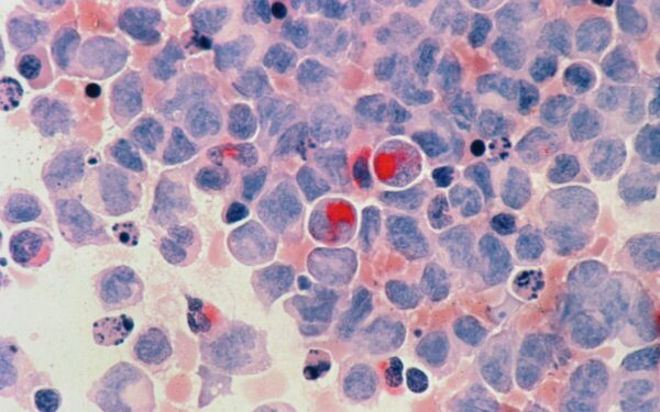 Mokslininkai apstulbo: ar vėžys gali siųsti signalus, apsaugančius smegenis nuo Alzheimerio?