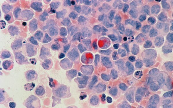 55 metai laukimo: pagaliau atkūrė retą medžiagą, kuri gali tapti ginklu prieš agresyvų vaikų vėžį