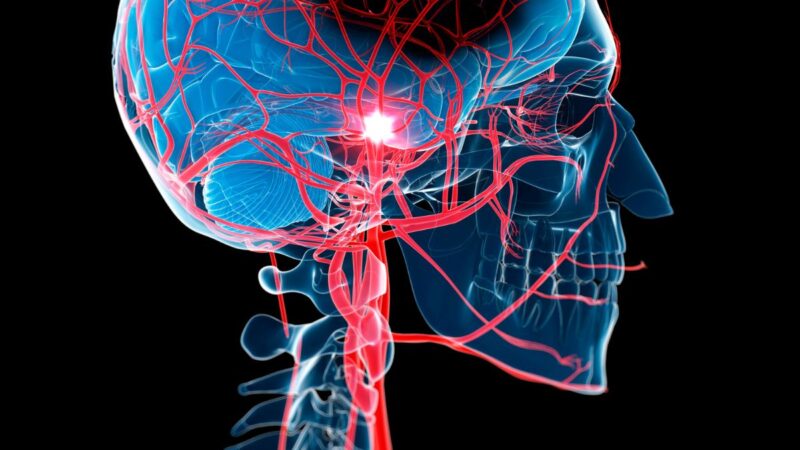 Neurologas perspėja: šie įpročiai gali padidinti kraujavimo į smegenis riziką ir sukelti insultą